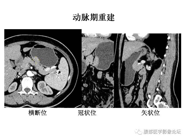 【病例】胃壁粘膜下占位3例CT影像表现