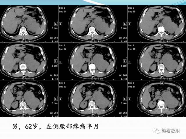 【病例】原发性肾淋巴瘤1例CT影像表现