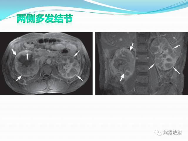 【病例】原发性肾淋巴瘤1例CT影像表现