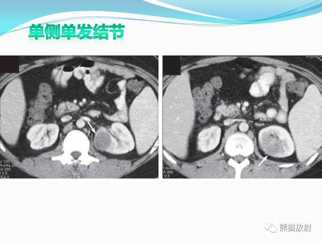 【病例】原发性肾淋巴瘤1例CT影像表现