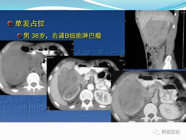 【病例】原发性肾淋巴瘤1例CT影像表现