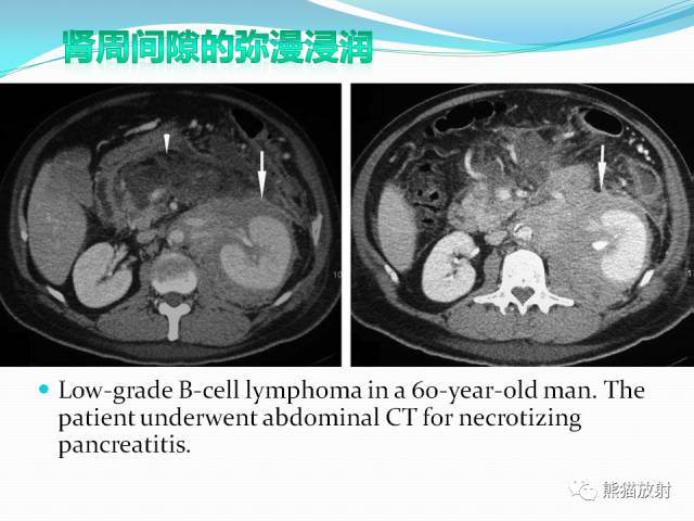【病例】原发性肾淋巴瘤1例CT影像表现