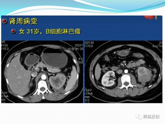 【病例】原发性肾淋巴瘤1例CT影像表现