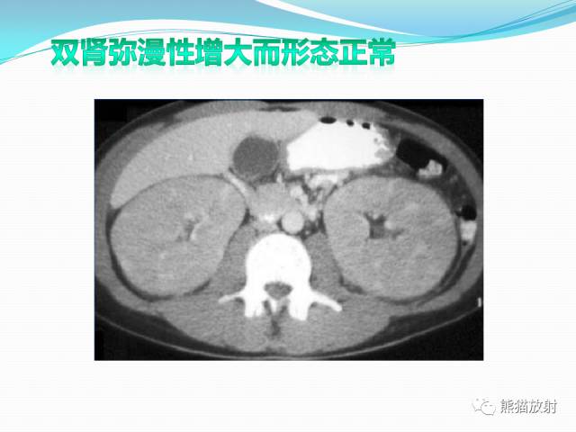 【病例】原发性肾淋巴瘤1例CT影像表现