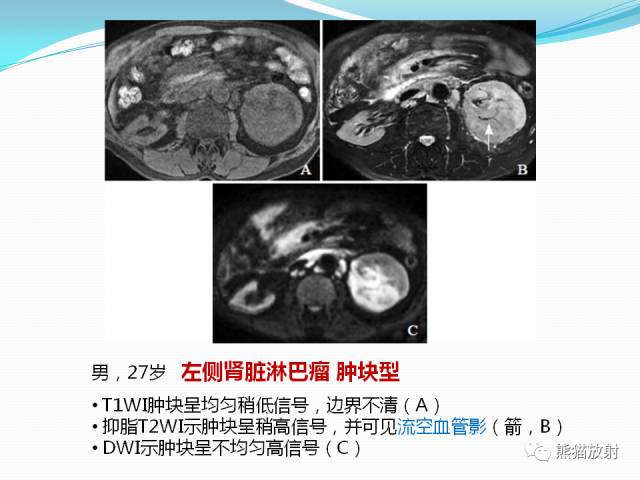 【病例】原发性肾淋巴瘤1例CT影像表现