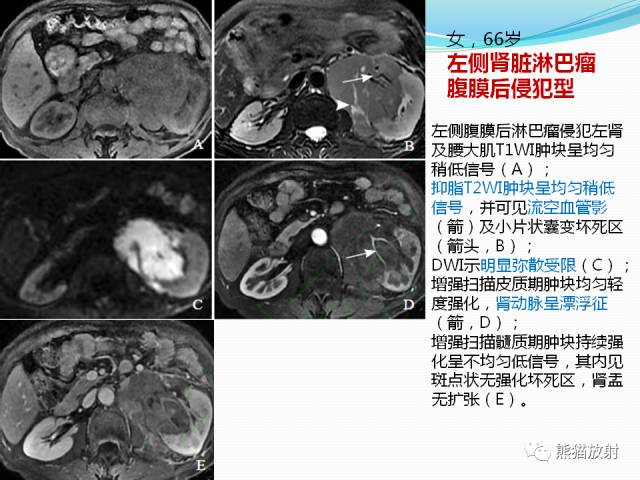 【病例】原发性肾淋巴瘤1例CT影像表现