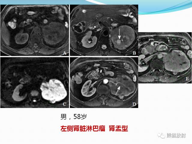 【病例】原发性肾淋巴瘤1例CT影像表现