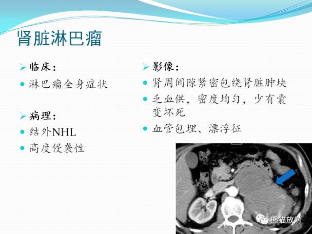 【病例】原发性肾淋巴瘤1例CT影像表现