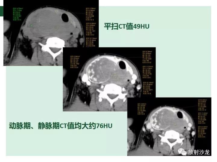【病例】甲状腺恶性淋巴瘤1例CT影像表现