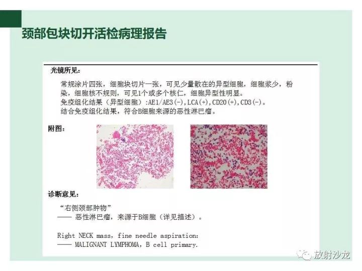 【病例】甲状腺恶性淋巴瘤1例CT影像表现
