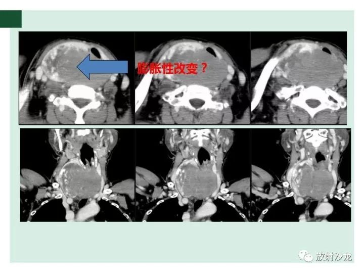【病例】甲状腺恶性淋巴瘤1例CT影像表现