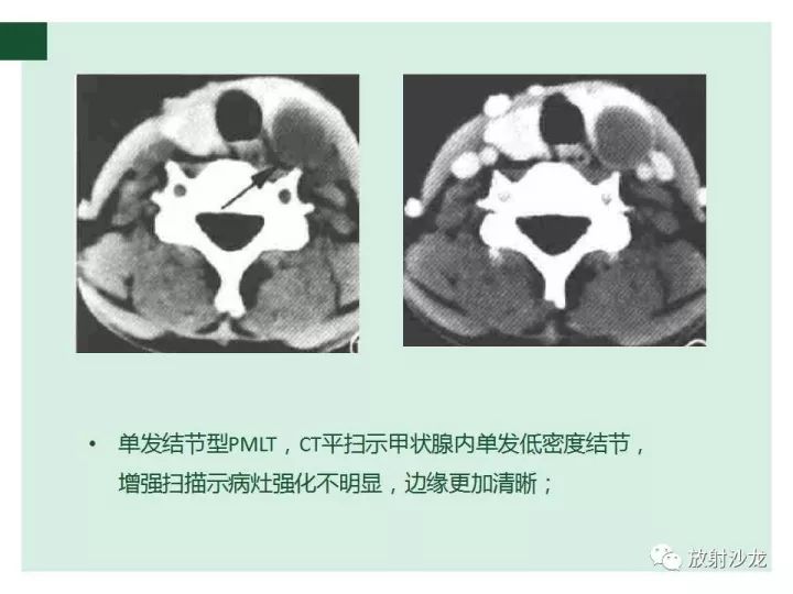 【病例】甲状腺恶性淋巴瘤1例CT影像表现