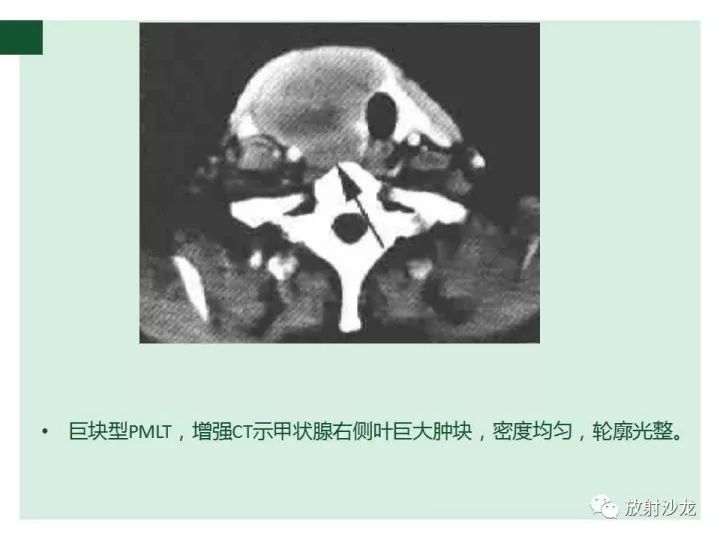 【病例】甲状腺恶性淋巴瘤1例CT影像表现