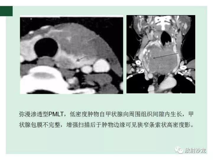 【病例】甲状腺恶性淋巴瘤1例CT影像表现