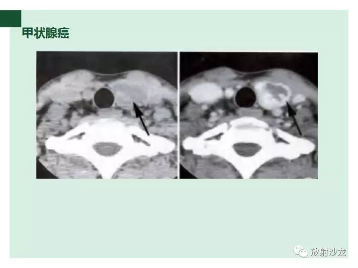 【病例】甲状腺恶性淋巴瘤1例CT影像表现