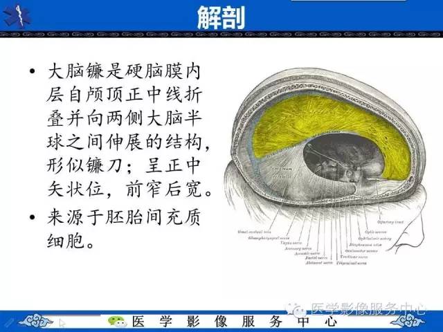 【PPT】易误诊为出血的大脑镰钙化