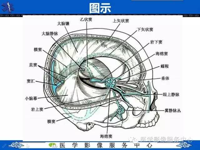 【PPT】易误诊为出血的大脑镰钙化