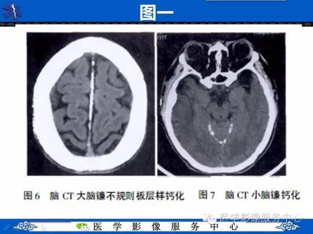 【PPT】易误诊为出血的大脑镰钙化