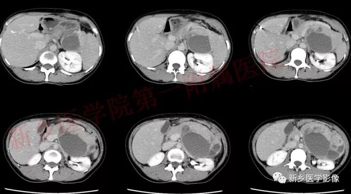 【病例】胃肠道外间质瘤1例CT影像表现 【病例】胃肠道外间质瘤1例CT影像表现