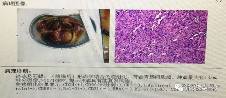 【病例】胃肠道外间质瘤1例CT影像表现 【病例】胃肠道外间质瘤1例CT影像表现