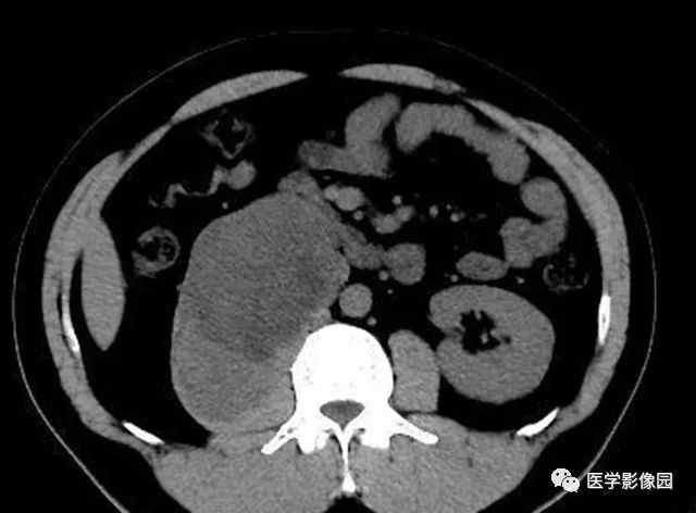 【病例】腹膜后神经鞘瘤1例CT影像表现 【病例】腹膜后神经鞘瘤1例CT影像表现