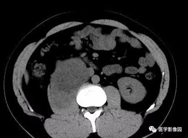 【病例】腹膜后神经鞘瘤1例CT影像表现 【病例】腹膜后神经鞘瘤1例CT影像表现