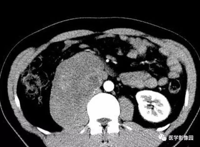 【病例】腹膜后神经鞘瘤1例CT影像表现 【病例】腹膜后神经鞘瘤1例CT影像表现