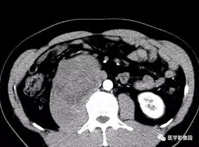 【病例】腹膜后神经鞘瘤1例CT影像表现 【病例】腹膜后神经鞘瘤1例CT影像表现