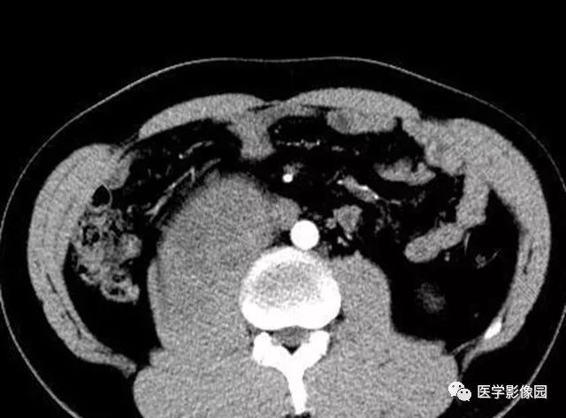 【病例】腹膜后神经鞘瘤1例CT影像表现 【病例】腹膜后神经鞘瘤1例CT影像表现