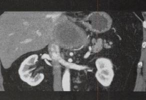 【病例】胰腺神经鞘瘤1例CT影像表现 【病例】胰腺神经鞘瘤1例CT影像表现