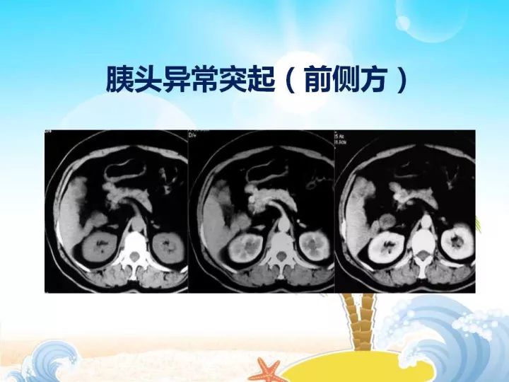 【PPT】胰腺肿瘤的影像诊断