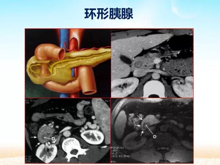 【PPT】胰腺肿瘤的影像诊断