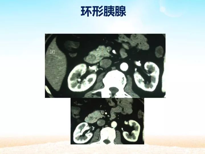 【PPT】胰腺肿瘤的影像诊断