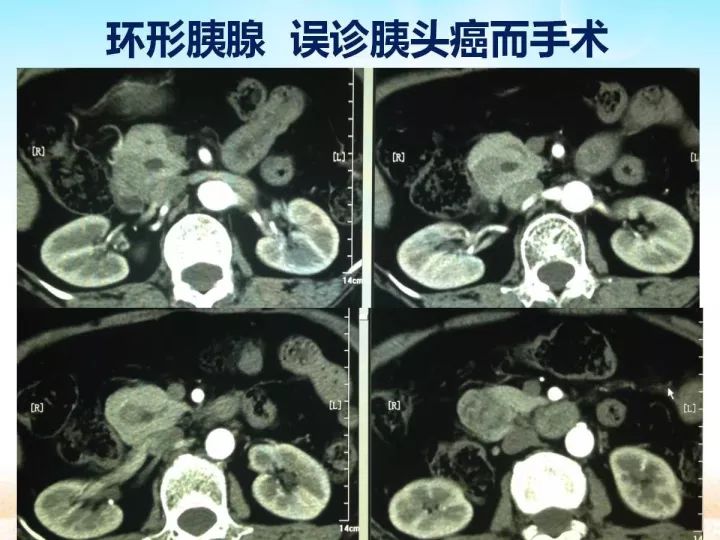 【PPT】胰腺肿瘤的影像诊断