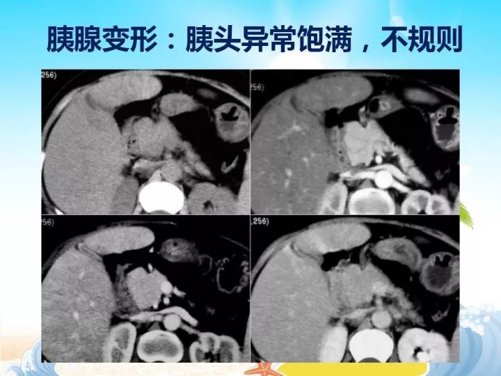 【PPT】胰腺肿瘤的影像诊断