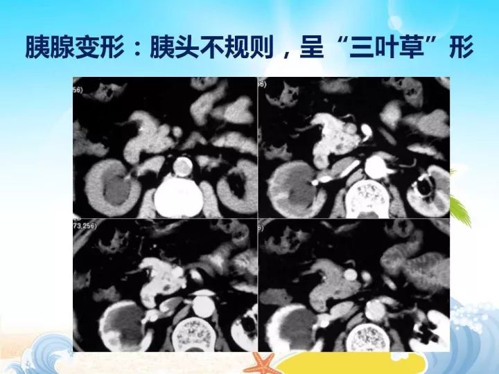 【PPT】胰腺肿瘤的影像诊断