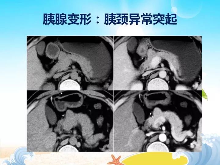【PPT】胰腺肿瘤的影像诊断