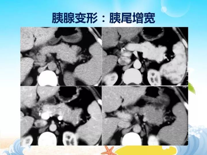【PPT】胰腺肿瘤的影像诊断