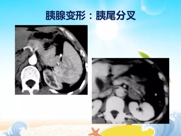 【PPT】胰腺肿瘤的影像诊断