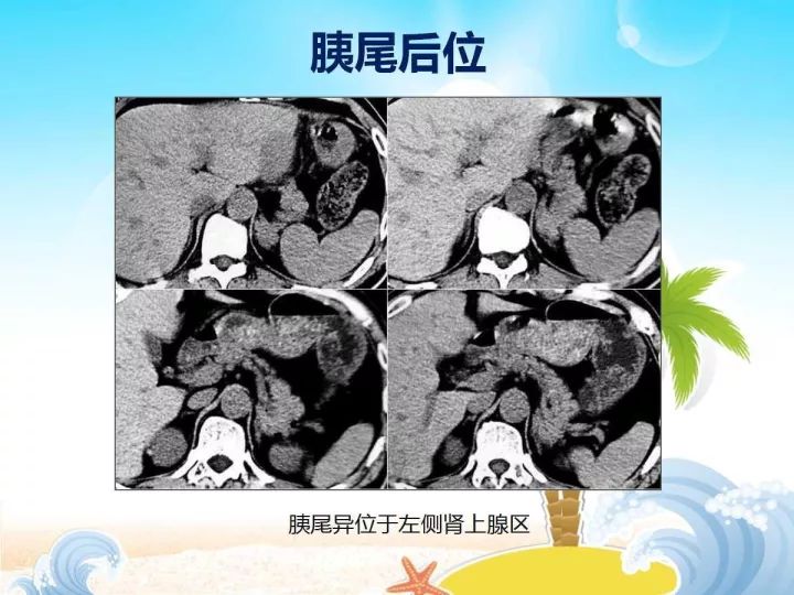 【PPT】胰腺肿瘤的影像诊断