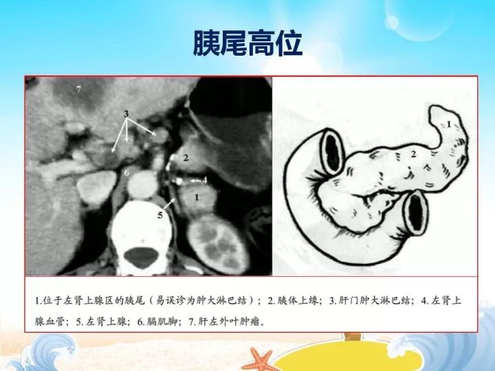 【PPT】胰腺肿瘤的影像诊断