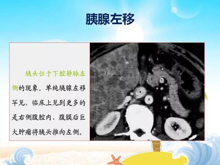 【PPT】胰腺肿瘤的影像诊断