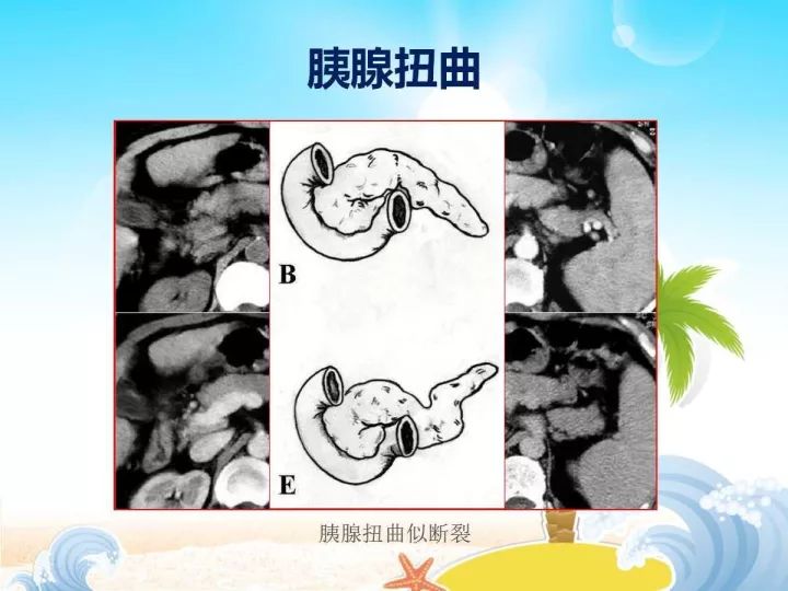 【PPT】胰腺肿瘤的影像诊断
