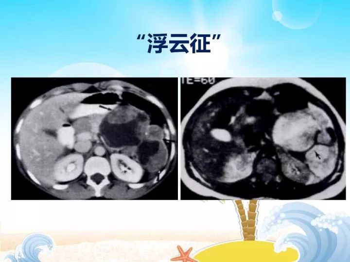 【PPT】胰腺肿瘤的影像诊断
