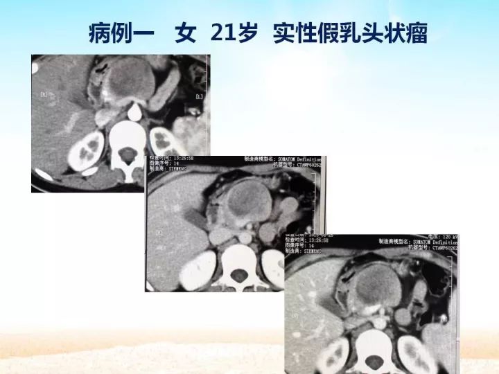 【PPT】胰腺肿瘤的影像诊断