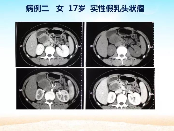 【PPT】胰腺肿瘤的影像诊断