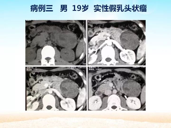 【PPT】胰腺肿瘤的影像诊断
