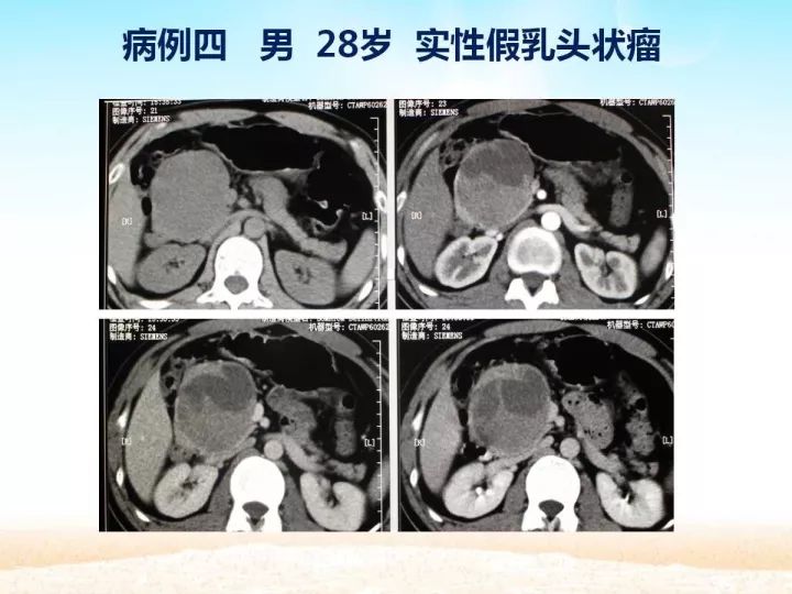 【PPT】胰腺肿瘤的影像诊断