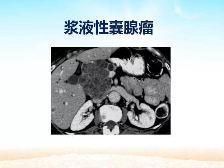 【PPT】胰腺肿瘤的影像诊断