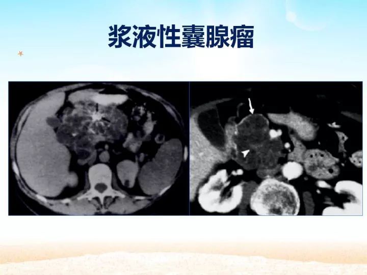 【PPT】胰腺肿瘤的影像诊断
